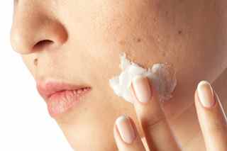 SOIGNER L'ACNE : se débarrasser des boutons d'acné (traitement ...