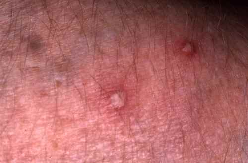 SOIGNER UN FURONCLE : se débarrasser d'un furoncle – Dermatologue ...