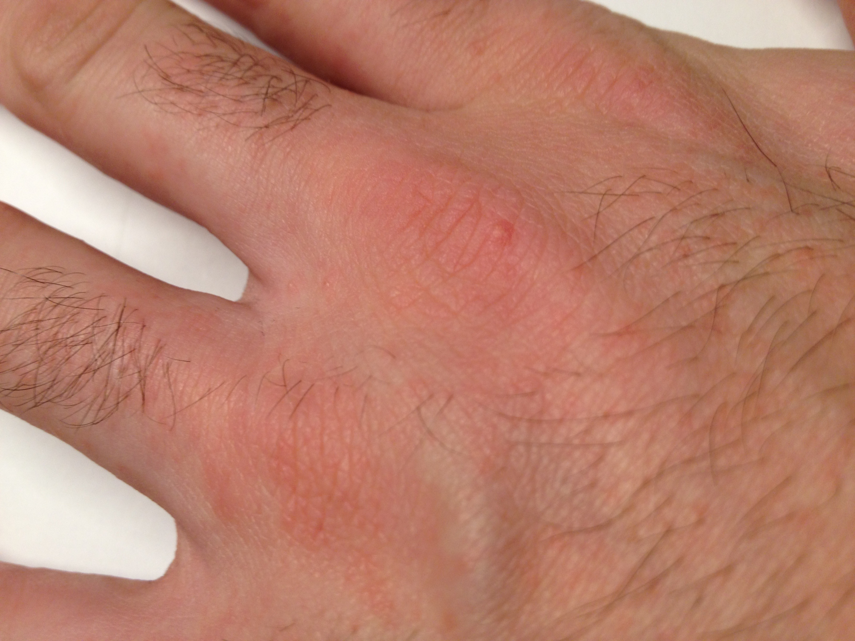 Scabies: Treatment and Scabies Rash Facts - MedicineNet