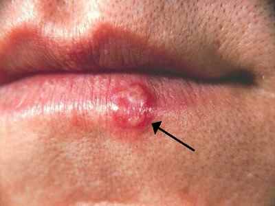 Soigner l'herpes de la lèvre