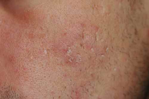 CICATRICES ACNE : atténuer les cicatrices d'acné sur le visage ...