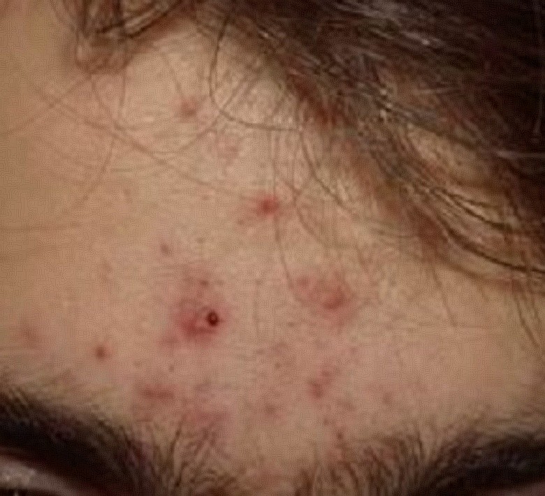 acne inflammatoire