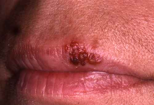 Herpes labial au stade crouteux