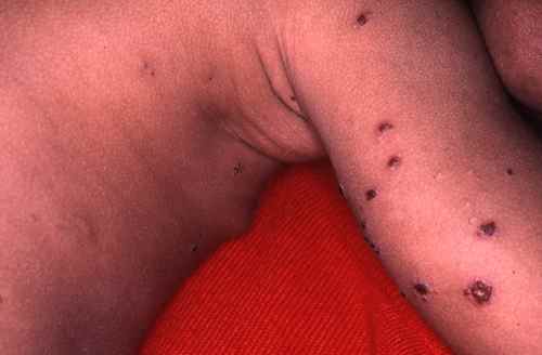 Croutes de varicelle : attention aux cicatrices