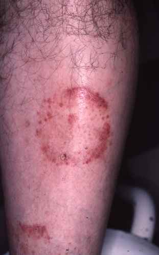 Mycose de la jambe