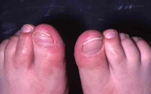 Aspect sec et qui pele sur les orteils et les pieds : c'est peut être une dermatose plantaire juvénile