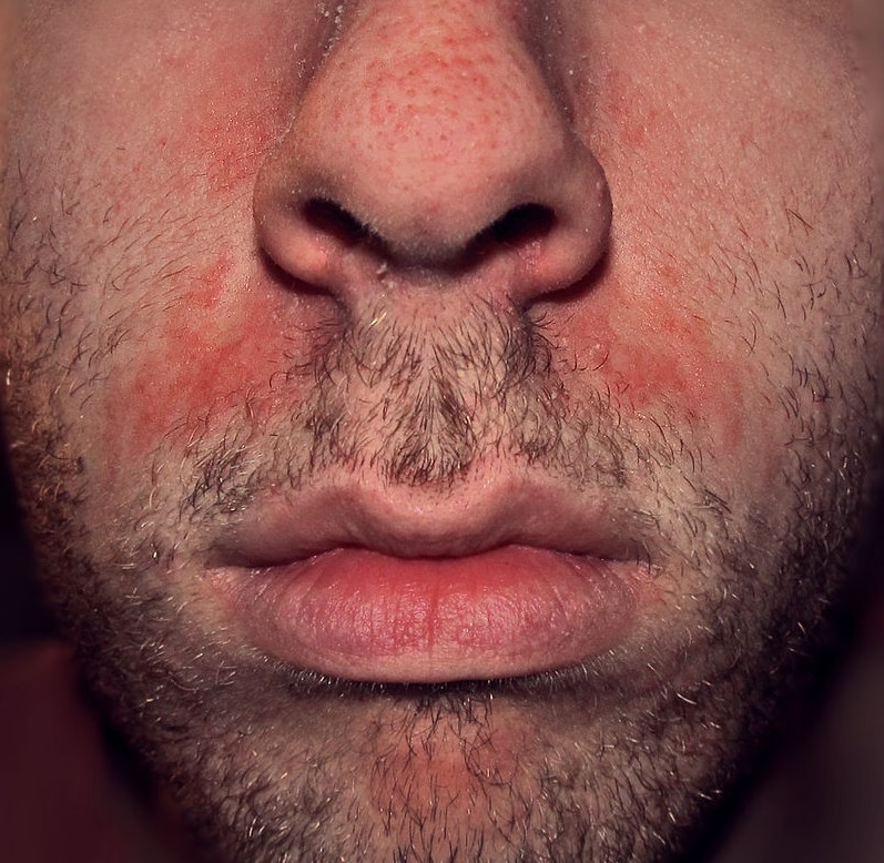 eczema seborrheique du visage
