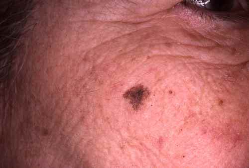 Mélanome (cancer de la peau)