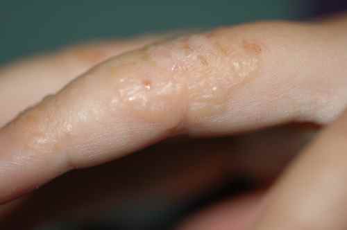 Allergie de contact de la main à type de dysidrose