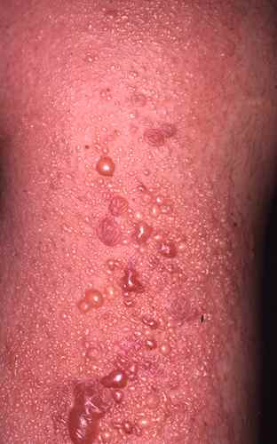 Eczema bulleux