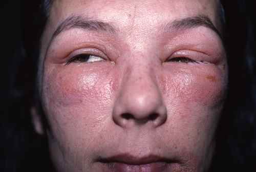 Eczema aigu du visage