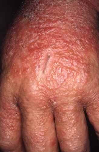 Eczema aigu vésiculeux de la main