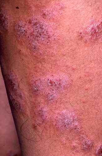 Eczema nummulaire chronique