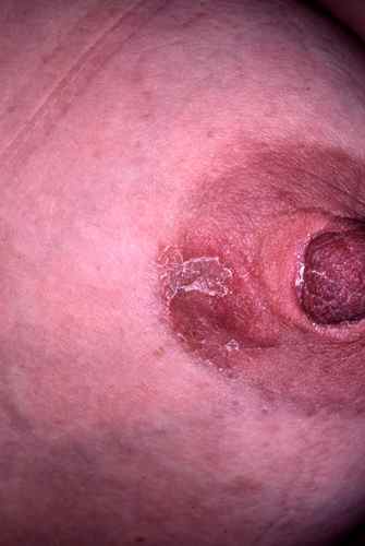 Un eczema unilatéral du mamelon : attention c'est peut etre une maladie de Paget