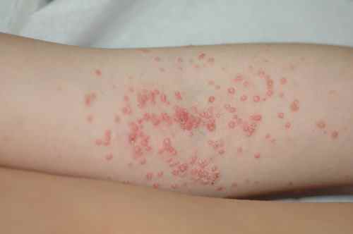 Molluscums contagiosums sur une plaque d'eczema atopique du coude