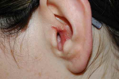 Eczema de l'oreille