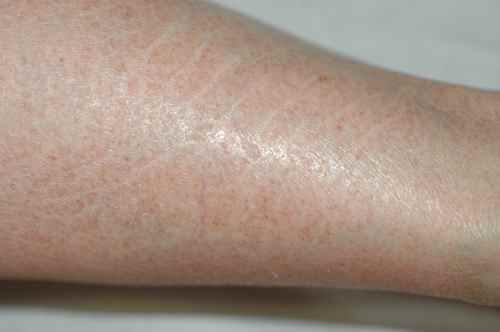 Eczema craquelé de la jambe