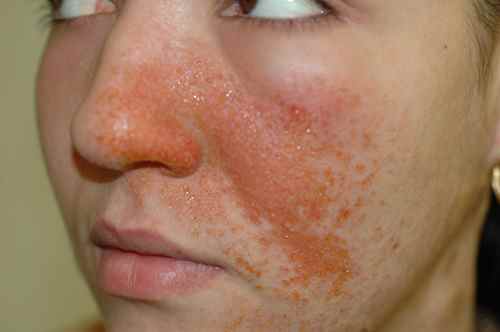 Eczema suintant du visage