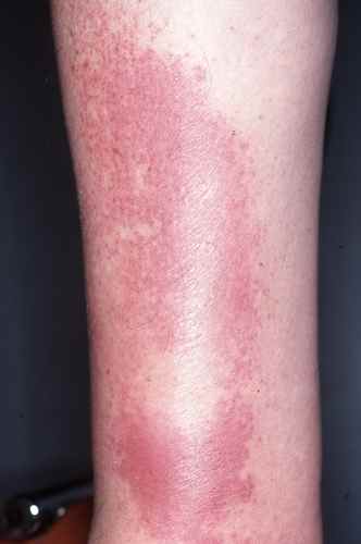 Erysipèlede la jambe (infection à bactéries)