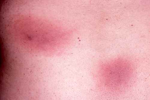 Erytheme pigmenté fixe au stade inflammatoire