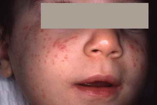 L'atteinte du visage est fréquente chez l'enfant alors qu'elle est exceptionnelle chez l'adulte, passant pour de l'eczema