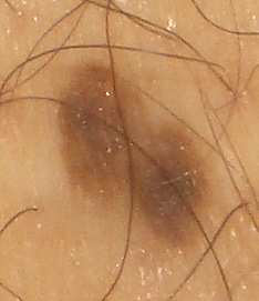 Grain de beauté à l'œil nu