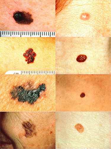 MELANOME : le mélanome de la peau – Dermatologue en téléconsultation
