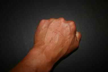 Granulome annulaire du dos de la main