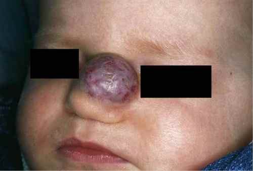 hemangiome du visage sur un bébé