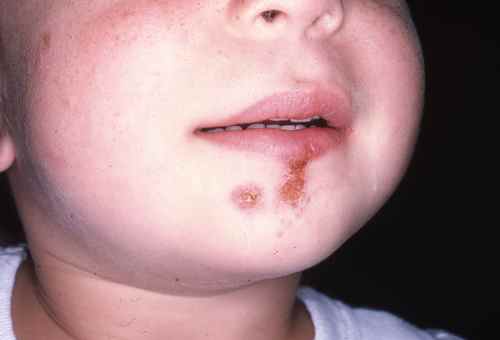 IMPETIGO : soigner l'impétigo de l'enfant – Dermatologue en ...