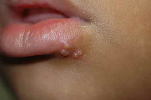 Herpes de la lèvre chez l'enfant
