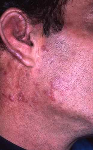 Lupus cutané chronique typique