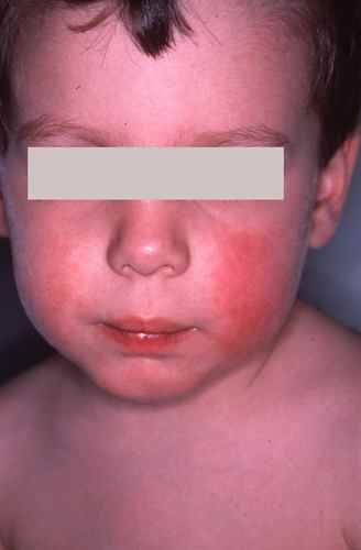 Joues rouges et fièvre chez l'enfant : mégalérythème épidémique?