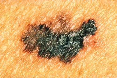 MELANOME : le mélanome de la peau – Dermatologue en téléconsultation