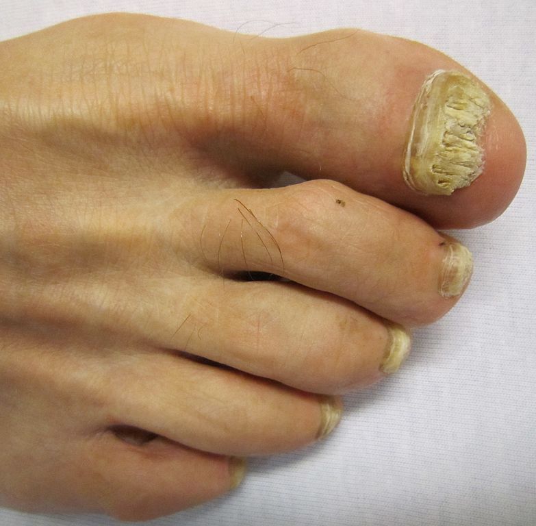 Mycose des ongles de pied