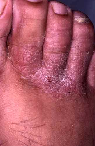 Mycose des pieds