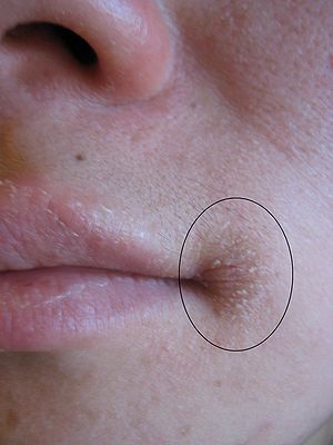 Perleche : peau sèche au coin des lèvres