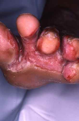 Surinfection à bacteries gram négatif d'une mycose des pieds