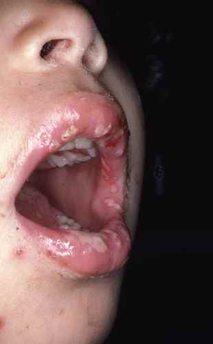 Primo infection à l'herpes