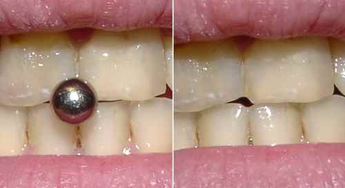 Usure des dents par un piercing