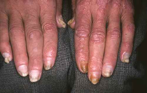 Psoriasis des ongles, avec atteinte de la peau et des articulations (rhumatisme psoriasique)