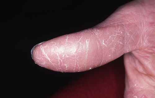 Pulpite ou fissure du doigt