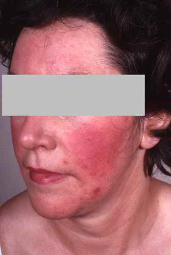 Rosacée : une cause de rougeurs du visage