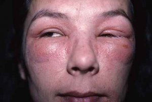 eczema visage