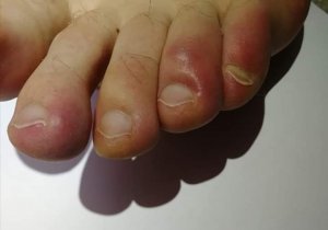 ENGELURES : gonflement violet douloureux des orteils (et des mains ...