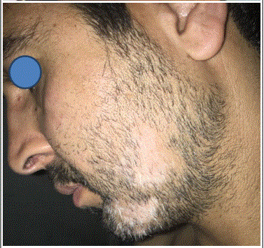 ZONE SANS POILS DE BARBE : la pelade de la barbe – Dermatologue en ...