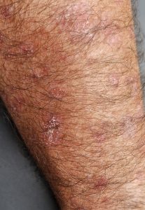 Consultation dermatologique à distance pour la porokératose.