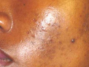 Maladie de peau – Dermatologue en téléconsultation