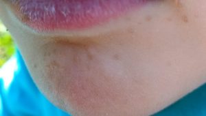 Verrues planes visage enfant